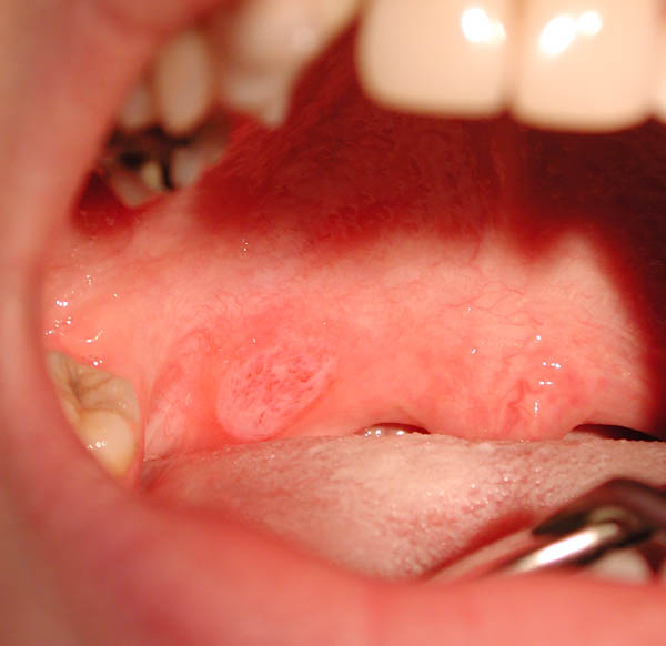 White Patch On Gums In Mouth