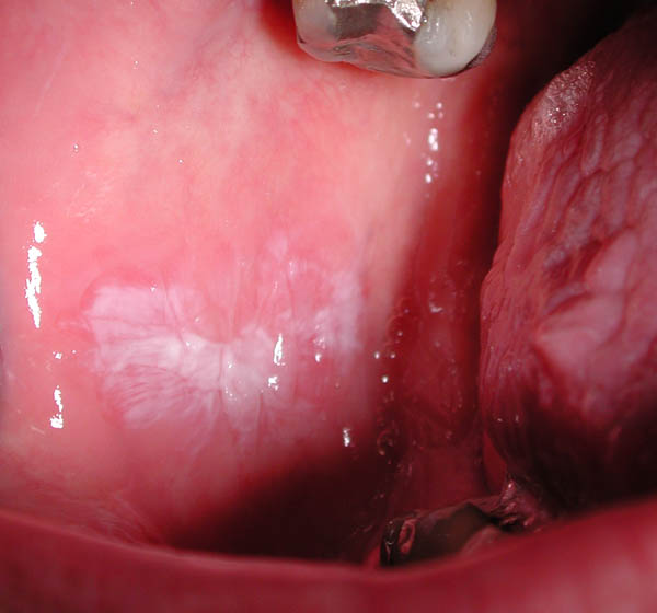 White Spots Inside Mouth 106