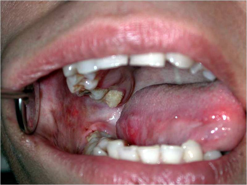 White Sore Patch In Mouth